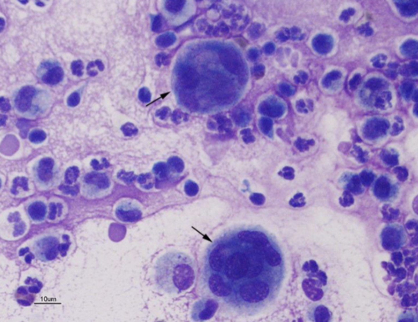 <p>What type of infiltrates is this?</p>