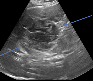 <p>-heterogenous (hypoechoic to targetoid to mixed)</p><p>-cavitation</p><p>- +/- peritoneal effusion</p>