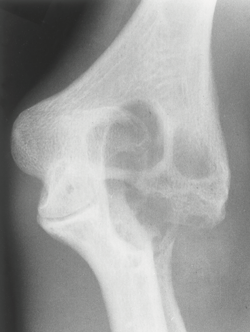 <p>is an <strong>inherited</strong> (by a sex-linked recessive gene) a<strong>nomaly of blood coagulation </strong>that appears clinically <strong>only in males.<span>&nbsp;</span></strong></p><ul><li><p>easily bruising externally and internally</p></li></ul><p></p>