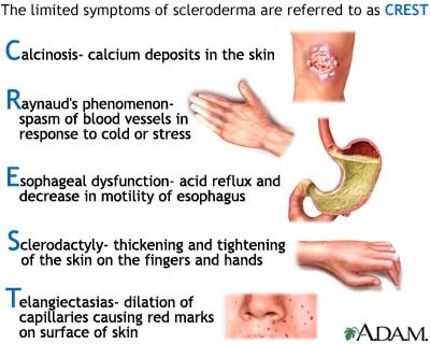 <p>Calcinosis, Raynaud's, Esophageal dysmotility, Sclerodactyly, Telangiectasia</p>