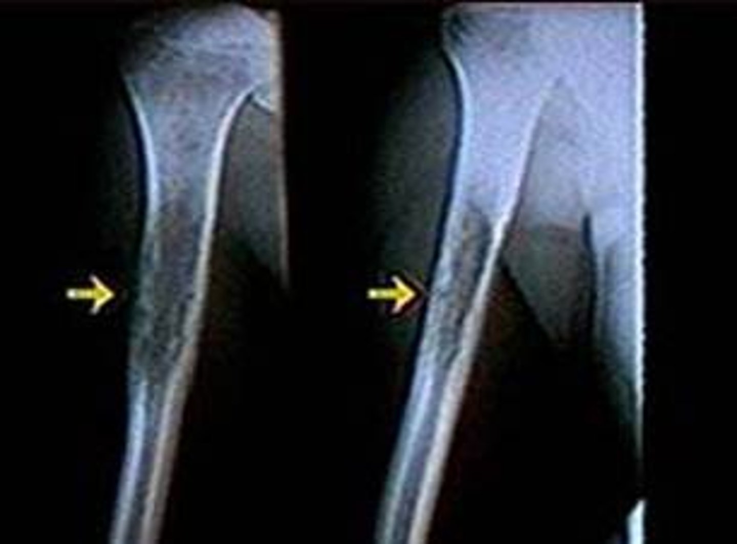 <p>Ewing's sarcoma</p>