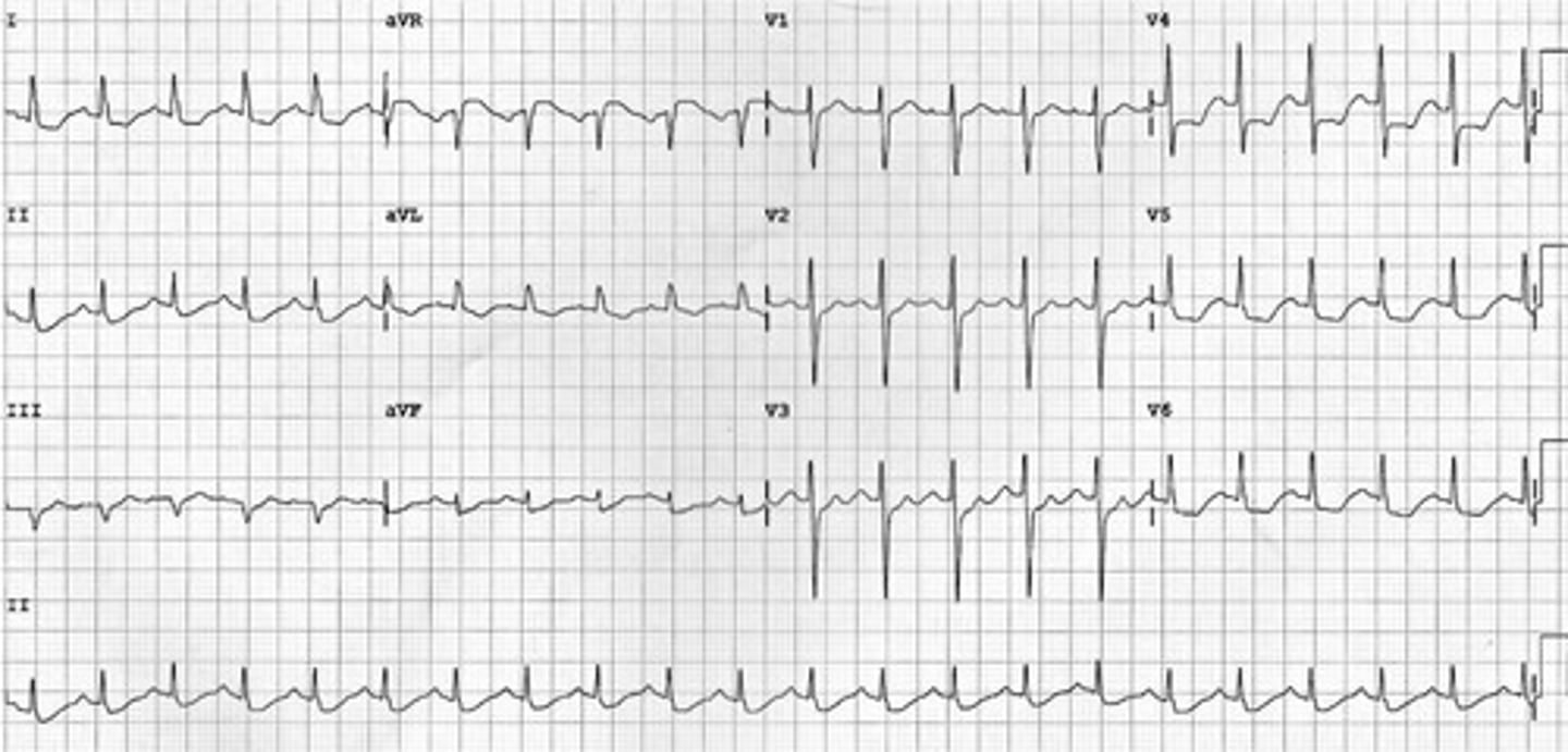 <p>Ischemia 6/7 - STEMI on ECG.</p>