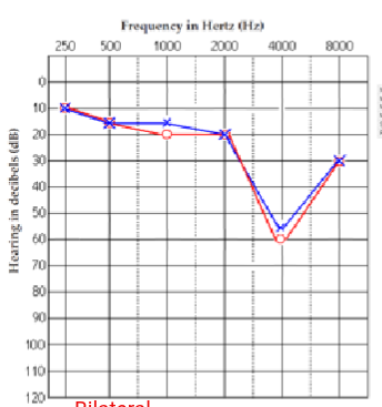 <p>what paitent is this? and what hearing loss do they have?</p>