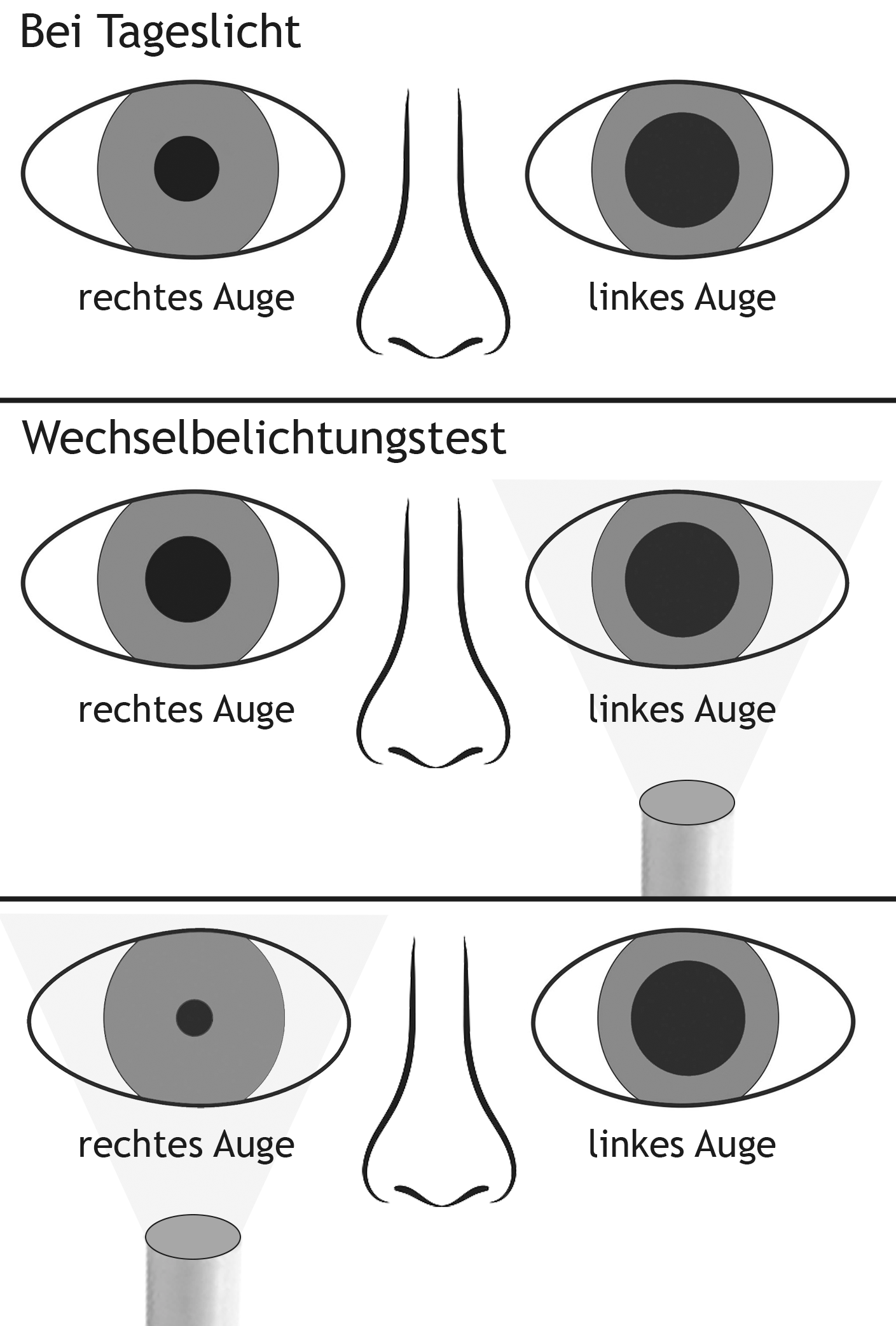 <p>24. In a 32-year-old female patient, the left pupil is larger than the right in daylight. During the swinging flashlight test in a dimly lit room, the pupil of each eye is alternately illuminated from below while the patient looks into the distance. The following findings are obtained:</p><p>Which of the following causes most likely underlies the findings shown in the illustration?</p><p>A. Isolated lesion of the left oculomotor nerve (N. oculomotorius)</p><p>B. Isolated lesion of the left ophthalmic nerve (N. ophthalmicus)</p><p>C. Isolated lesion of the right optic nerve (N. opticus)</p><p>D. Lesion of the left optic nerve (N. opticus) and the left oculomotor nerve (N. oculomotorius)</p><p>E. Lesion of the right optic nerve (N. opticus) and the left oculomotor nerve (N. oculomotorius)</p>