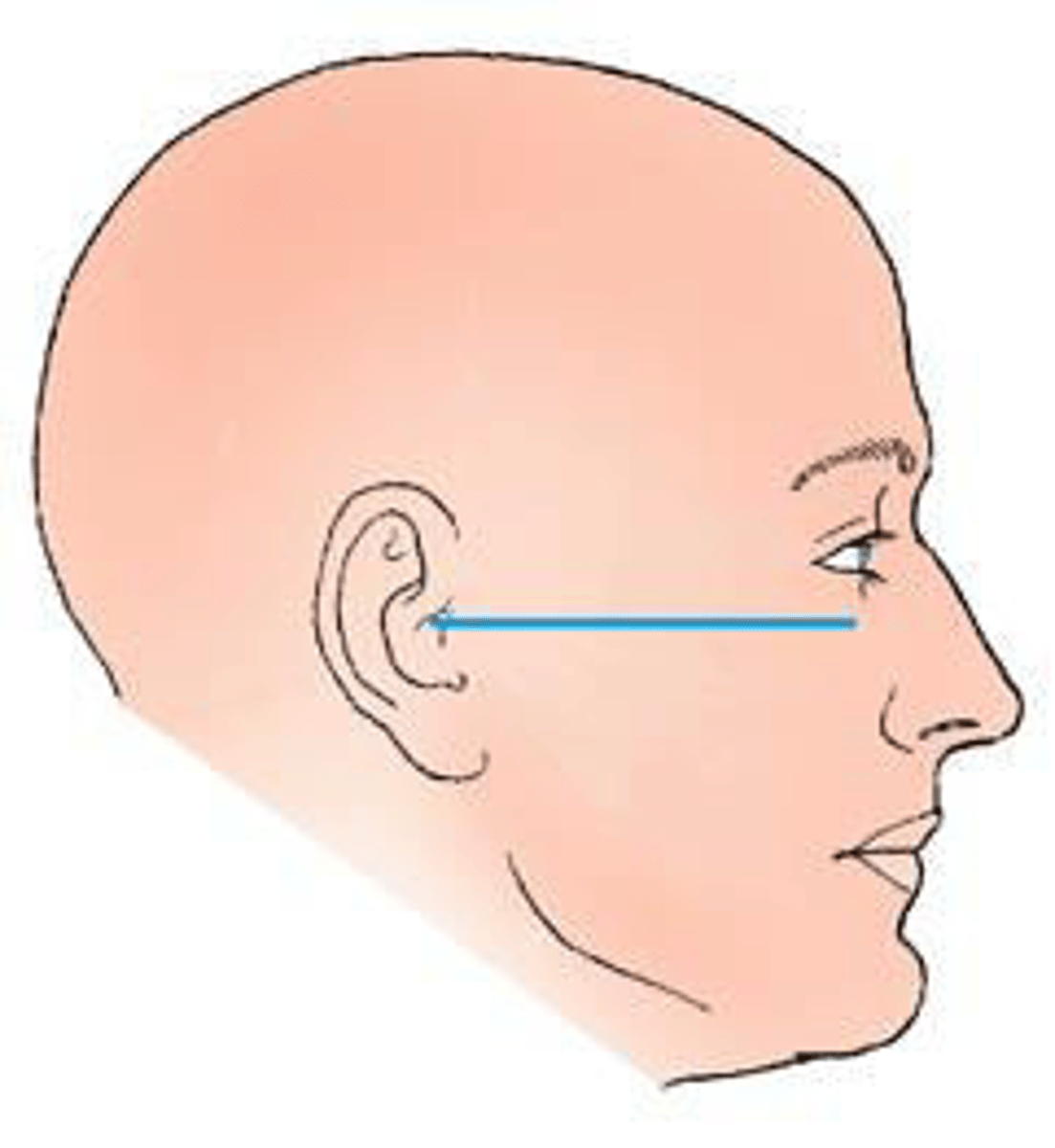 <p>d. infraorbitomeatal.</p><p>3 multiple choice options</p>