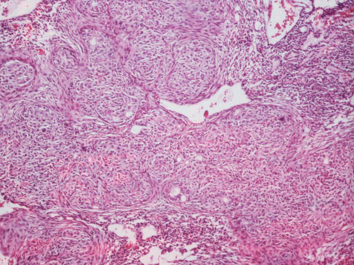 <p>• Well-defined lesion usually surrounded by thick fibrous capsule</p><p>• Spindle-shaped epithelial cells in sheets, strands, or whorled masses of cells in scant fibrous stroma</p><p>• Tubular or duct-like structures</p><p>• Scattered calcifications represent abortive enamel formation, dentinoid, or cementum</p>