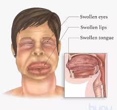 <p>Severe type of hypersensitivity type 1, usually caused by NSAIDs &amp; ACEI</p>