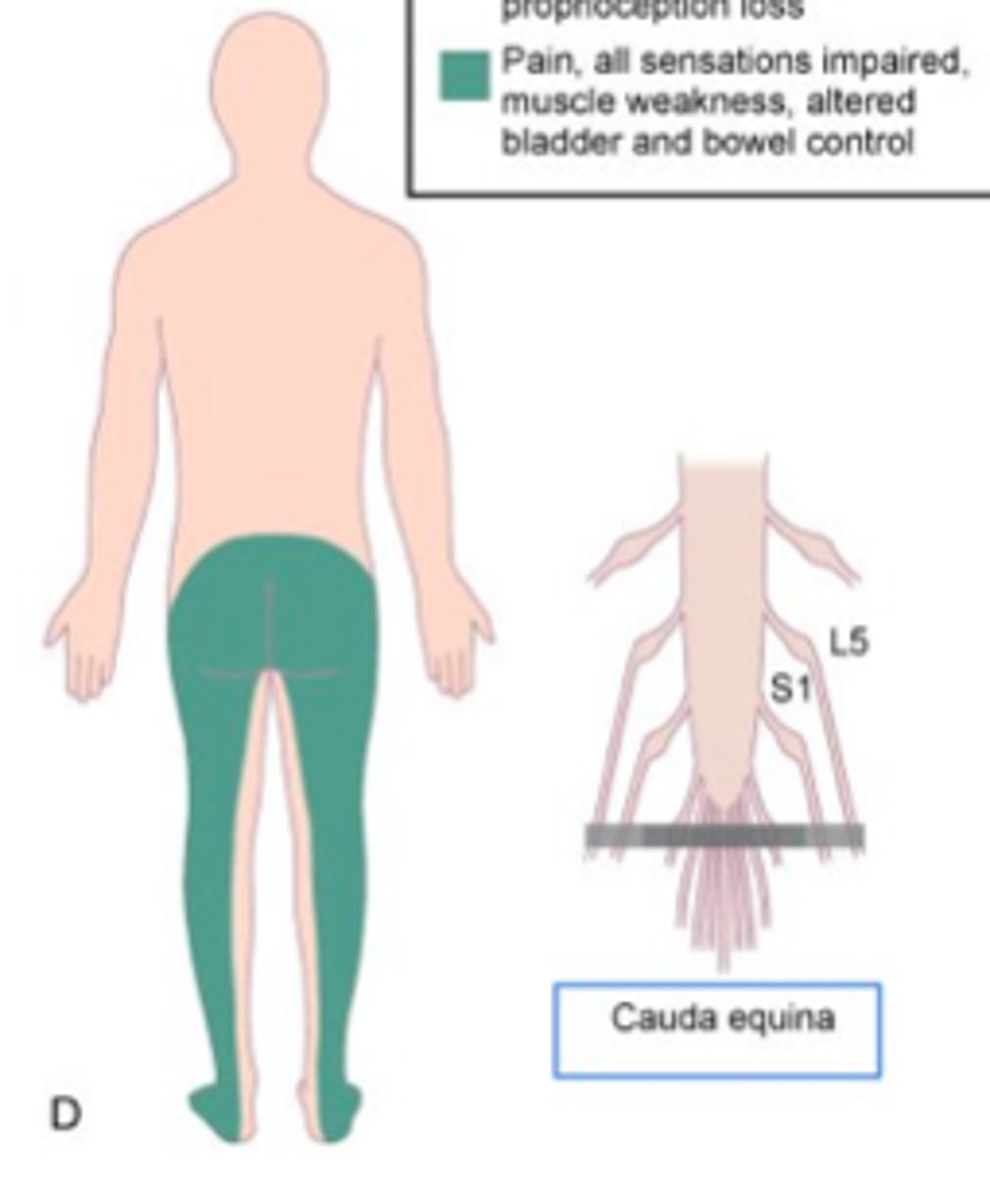 <p>o Asymmetrical distal weakness w/ flaccid paralysis of Les</p><p>o Loss of sensation in saddle area</p><p>o Areflexic bladder and bowel</p><p>o Severe pain</p>