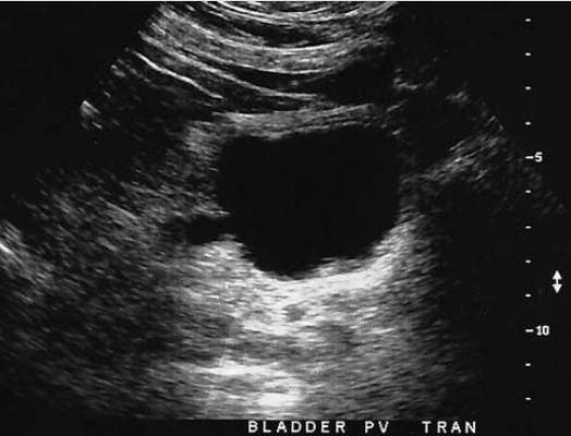 <p>a patient presents with a history of uncontrolled hypertension and painless hematuria. A hyper vascular complex mass is identified near renal hilum. What is this most sus for</p>