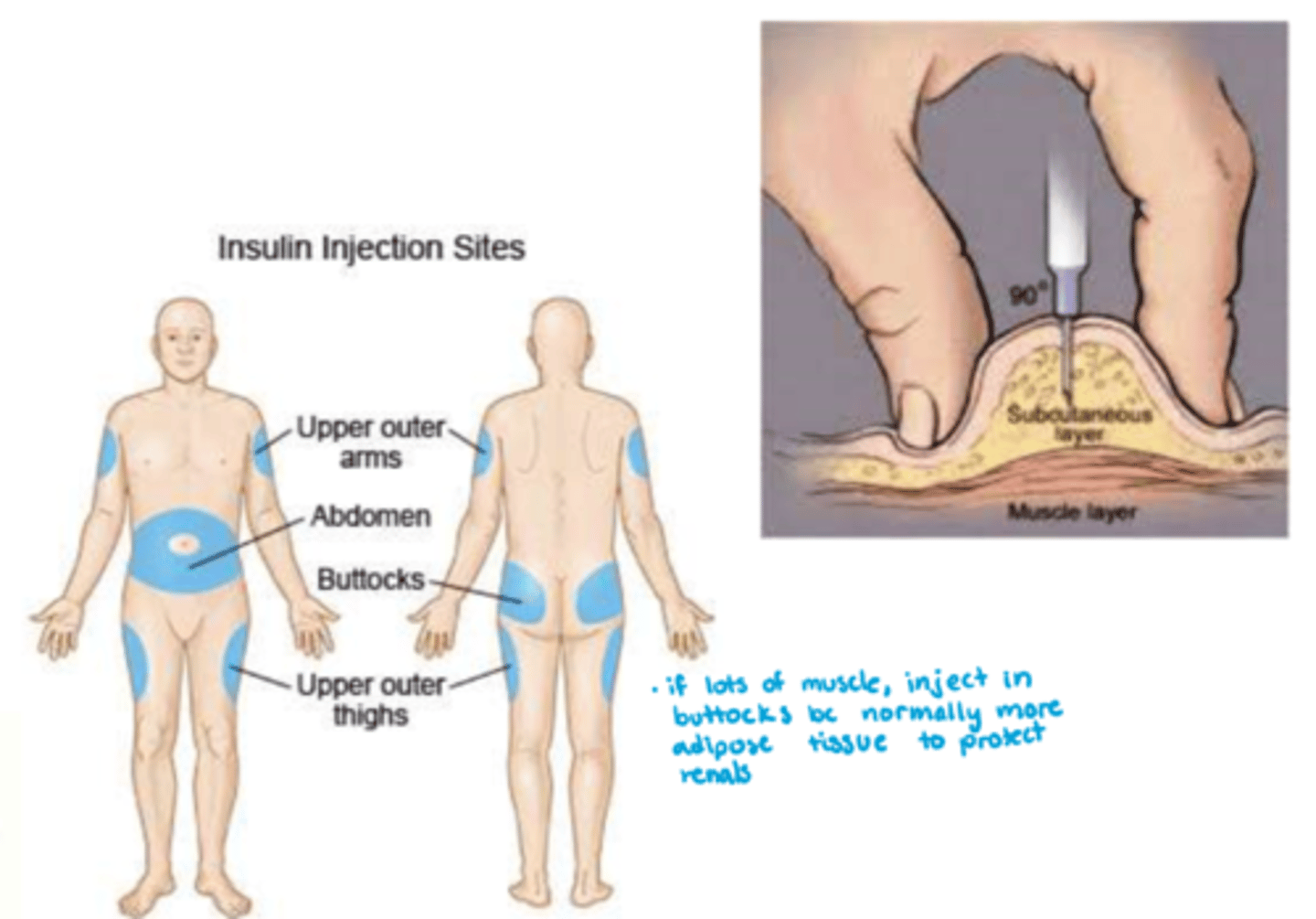 <p>- route: SC (note: IV utilized in critically ill patients) (want SC b/c muscle has too much perfusion)</p><p>- abdomen most commonly utilized unless you have a legit 8 pack!</p><p>- formulation: needle injections, portable pen injectors, insulin pumps - basal & bolus delivery</p>