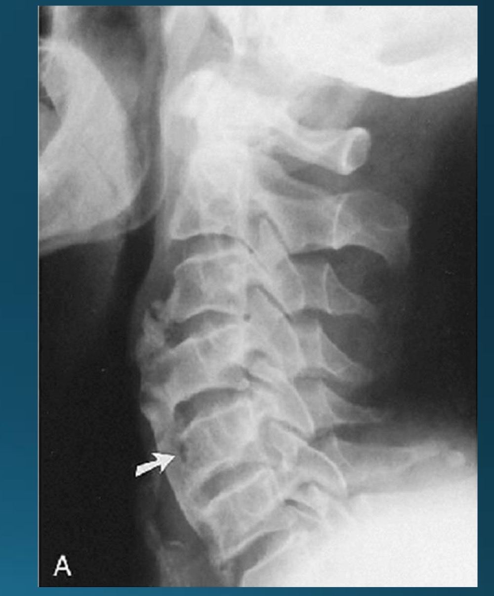 <p>what symptoms would you potentially expect with this radiograph? </p>