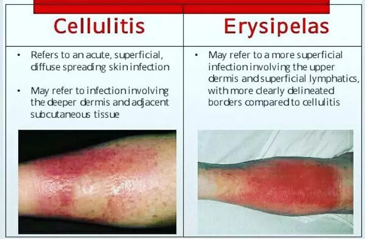 <p>PP: superficial cellulitis of the upper dermis that extends to superficial cutaneous lymphatics</p><p>E: abrupt onset<br>rapid progression</p><p>CM: painful macular rash<br>well-defined margins<br>fiery red rash<br>face→progression to extremities</p><p>TX:<br>PO penicillin x 10-14 days<br>IV penicillin x 10-14 days<br>desquamates x 5-10 days</p>