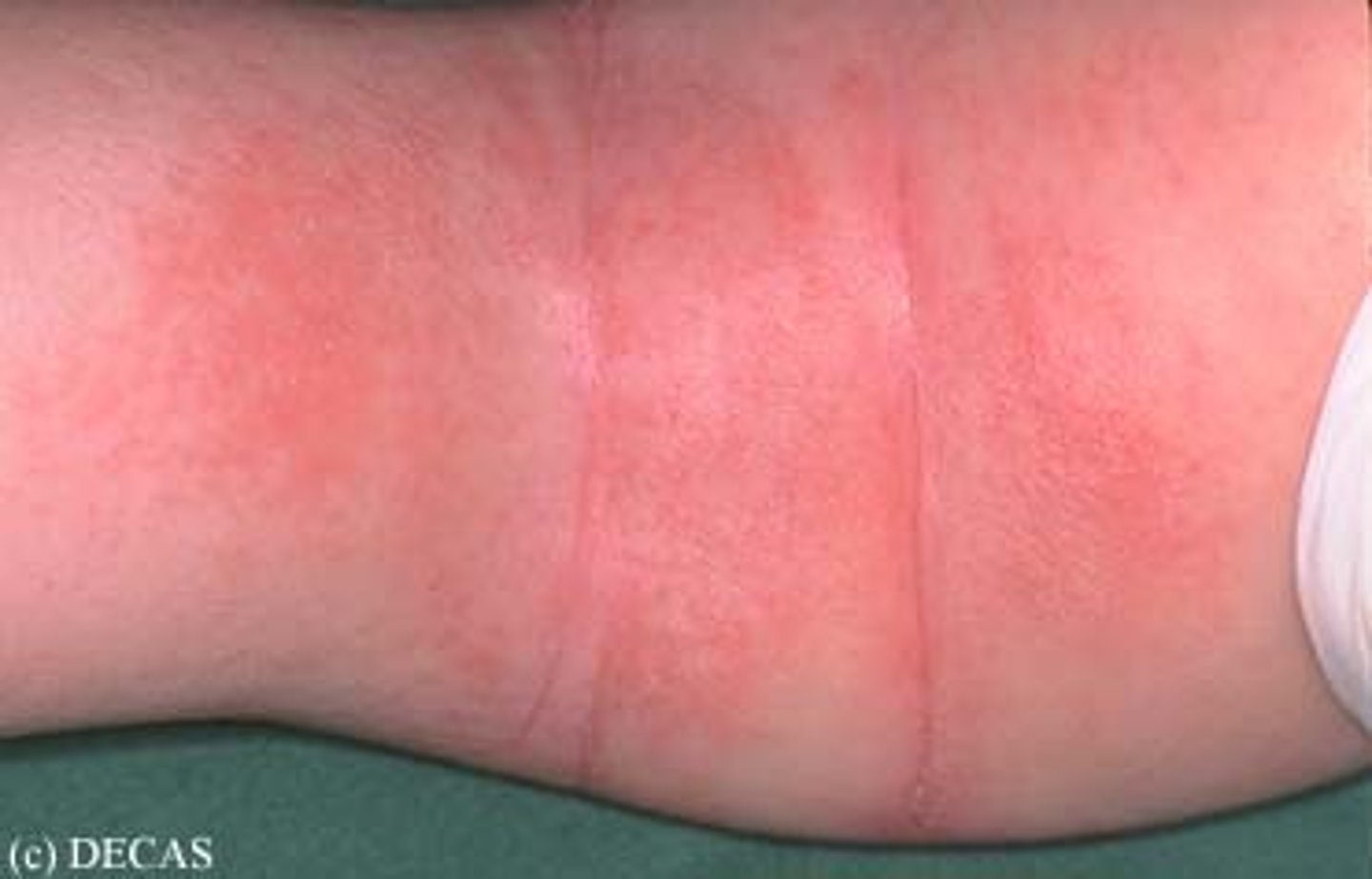 <p>Redness of the skin or mucous membranes</p>