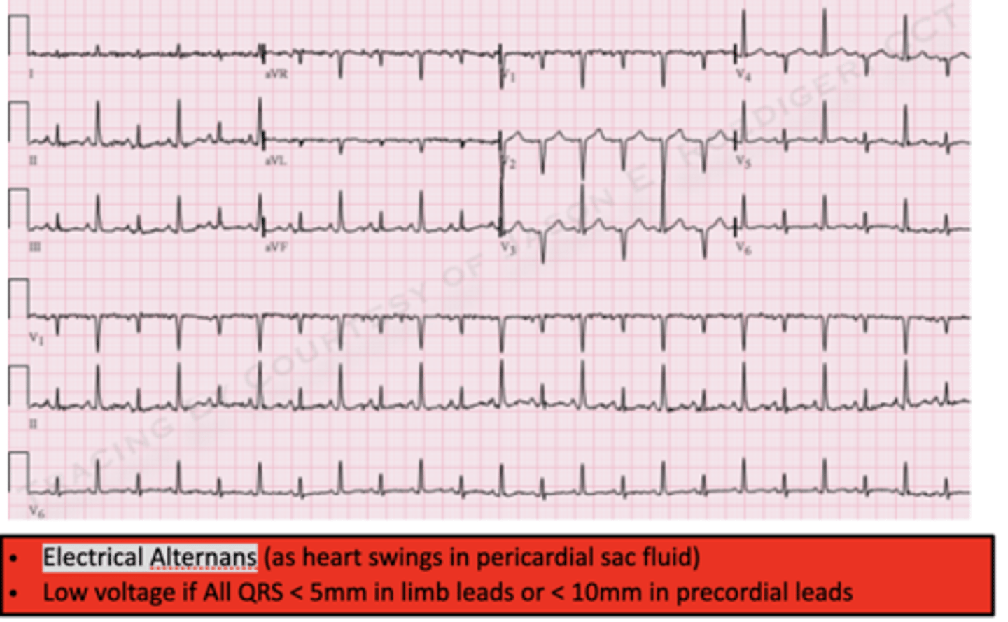 <p>Cardiac Tamponade</p><p>**Also Beck's triad &amp; "water bottle" appearance on CXR</p>