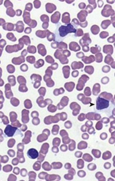 <p>8.5 Side A (PBD9: 360; BP9: 426)<br></p>
<p><br></p>
<p>Questions<br></p>
<p>A 21-year-old man has fever, sore throat, and malaise. WBC count shows atypical lymphocytes; heterophile antibody titer is positive.<br></p>
<p><br></p>
<p>1. What does the peripheral smear show?<br></p>
<p>2. What infectious disease does he have, and how is it spread?<br></p>
