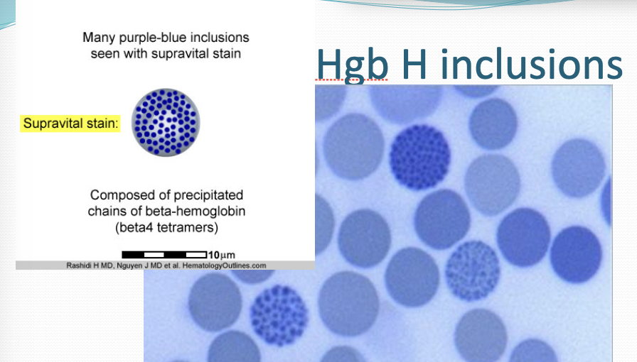 <p>Alpha Thalassemia</p>