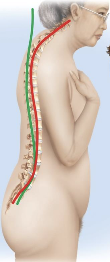 <p>what abnormal curvature is depicted</p>