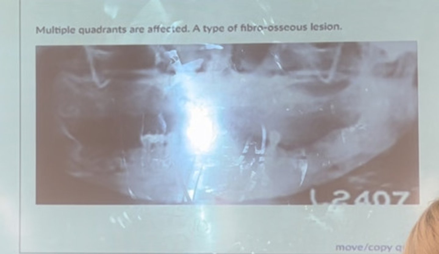 <p>Multiple quadrants are affected. A type of fibrous osseous lesion</p>