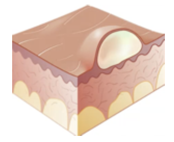 <p>Primary Skin Lesion</p><ul><li><p><strong>Fluid-filled</strong> lesion of <strong>less than 0.5 cm</strong></p></li><li><p>E.g. herpes simplex</p></li></ul><p></p>