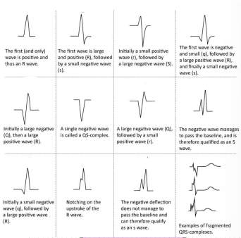 <p>Types of QRS complex</p>