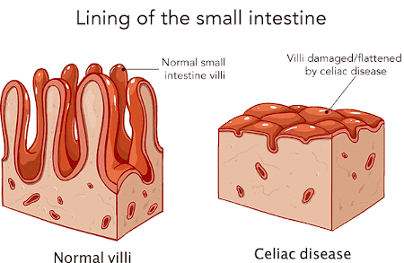 <p>What is celiac?</p>