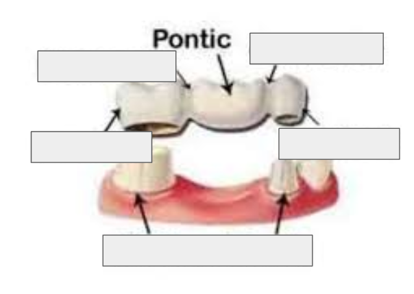 <p>The false tooth that replaces the missing tooth in a bridge.</p>