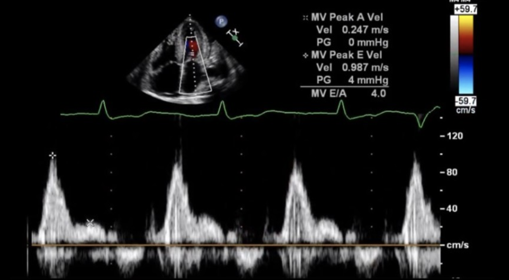 <ol><li><p>Non-dilated LV</p></li><li><p>Thick walled LV </p></li><li><p>EF 63%</p></li><li><p>E/A 2.1 </p></li><li><p>E/E 19</p></li><li><p>Moderate biatrial enlargement </p></li><li><p>Moderate pulmonary HTN</p></li><li><p>RVH</p></li><li><p>Dilated IVC </p></li></ol><p></p>