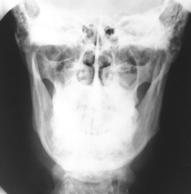 <p>What is this x-ray demonstrating?</p>