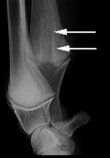 <ul><li><p><strong>Cause</strong></p><ul><li><p><strong>Young Lg dogs</strong></p></li><li><p>Unknown</p></li><li><p><strong>core of cartilage in the metaphysis</strong></p></li><li><p>issue of osteochondrosis of the distal ulnar physis</p></li><li><p>cartilage does not transform into bone</p></li></ul></li><li><p><strong>CS</strong></p><ul><li><p><strong>self limiting</strong></p></li><li><p>retard growth of the distal ulnar physis causing <strong>angular limb deformit</strong>y</p></li></ul></li><li><p><strong>RS</strong></p><ul><li><p>Conical shaped radiolucent zone extending from the distal ulnar physis into the distal ulnar metaphysis</p></li></ul></li></ul><p></p>