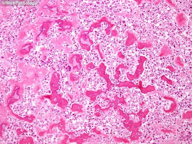 <p>Tumeur de la mandibule </p><p>1) Diagnostic</p><p>2) Localisation</p><p>3) Histologie</p><p>4) IHC</p><p>5) Moléculaire </p><p>6) DD princpial </p>