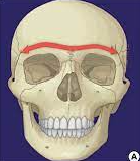 <p>frontal; thick margin of the eye socket that lies beneath the eyebrows</p>