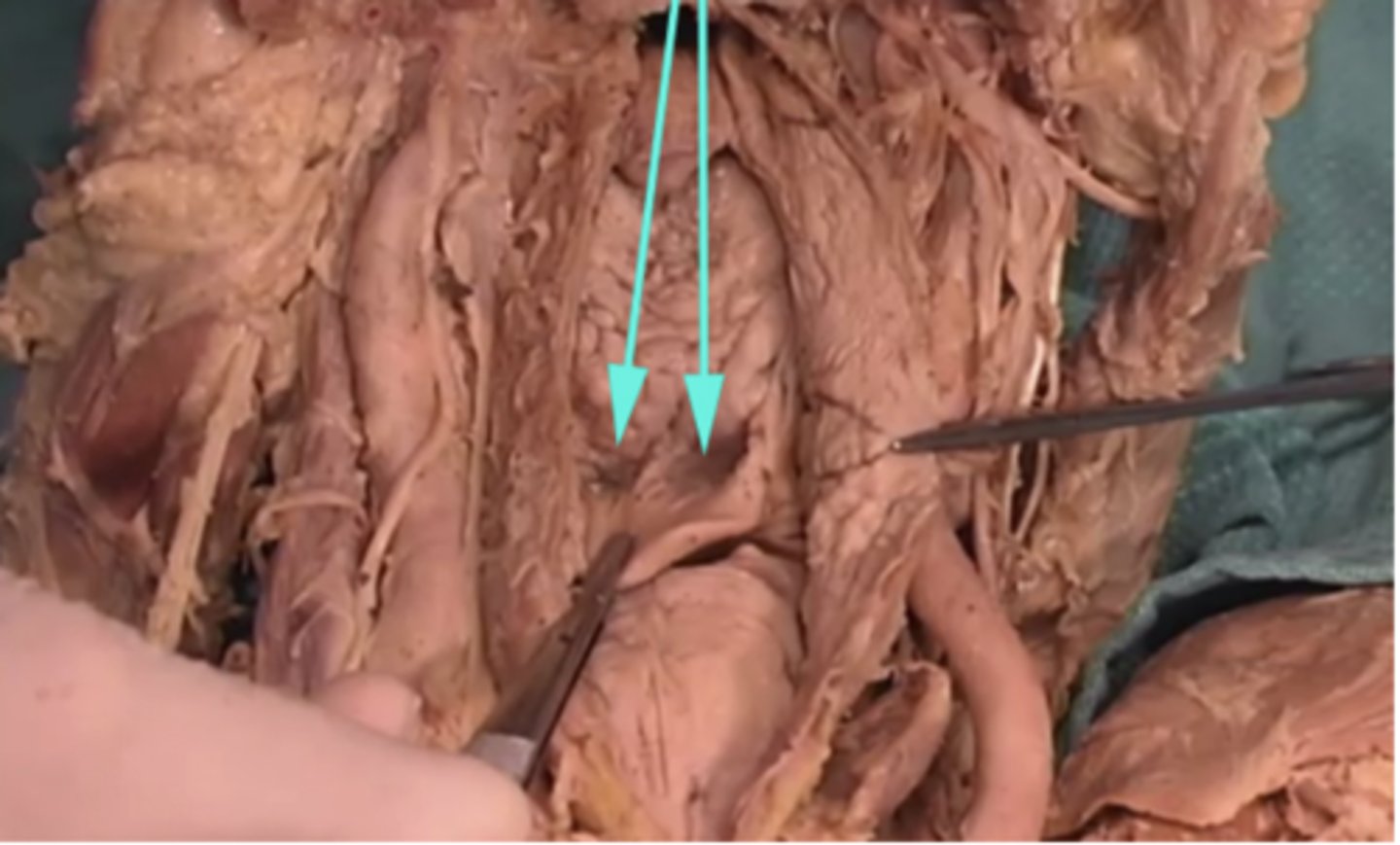 <p>What are these two depression regions named?</p><p>-Superior phrenic artery</p><p>-Epidermal fascia</p><p>-Vallecula epiglottica</p><p>-Uvula</p>