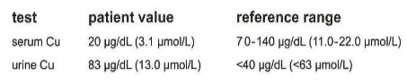 <p>296.) Serum and urine copper levels are assayed on a hospital patient with the following results. This is most consistent with: </p><p>A. normal copper levels </p><p>B. Wilms tumor </p><p>C. Wilson disease </p><p>D. Addison disease</p>
