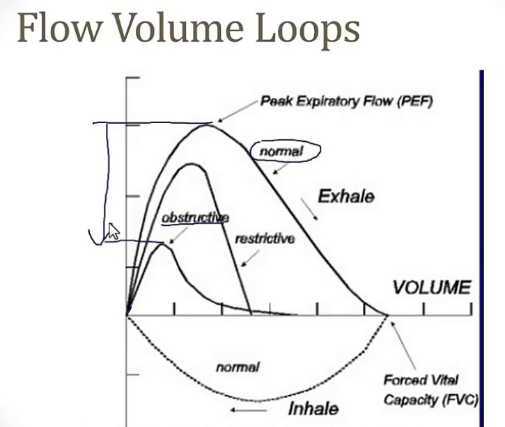 <p>-spirometry; volume flow; volume</p><p>-PEF(peak expiratory flow); obstructive; drop significantly</p>