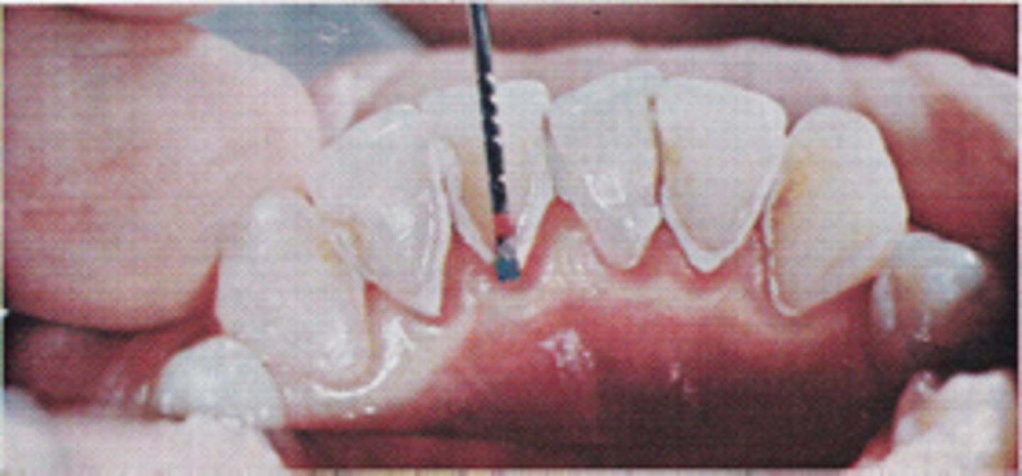 <p>it measures the supragingival calculus formation after a prophy and is widely used in testing new products</p>