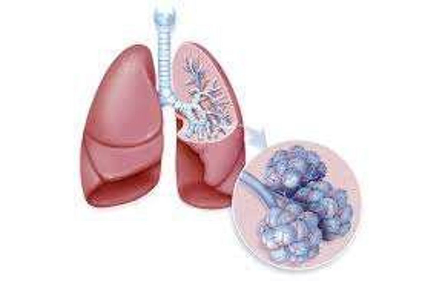 <p>Fluid accumulation in lung air sacs.</p>
