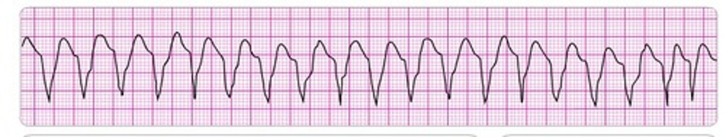 <p>Most often occurs after MI</p><p>Rare in normal hearts</p><p>Serious as it is a precursor to v-fib</p><p>If the rate is fast or sustained, hemodynamic compromise.</p><p>s/s: hypotension, ischemic chest pain, pulmonary edema, ↓ LOC/unconsciousness.</p><p>Tx: stable - amiodarone, unstable - cardioversion, pulselessness - defib + cpr, long term - ICD.</p><p>VT = wide QRS, regular rhythm, always assess pulse and stability FIRST</p>