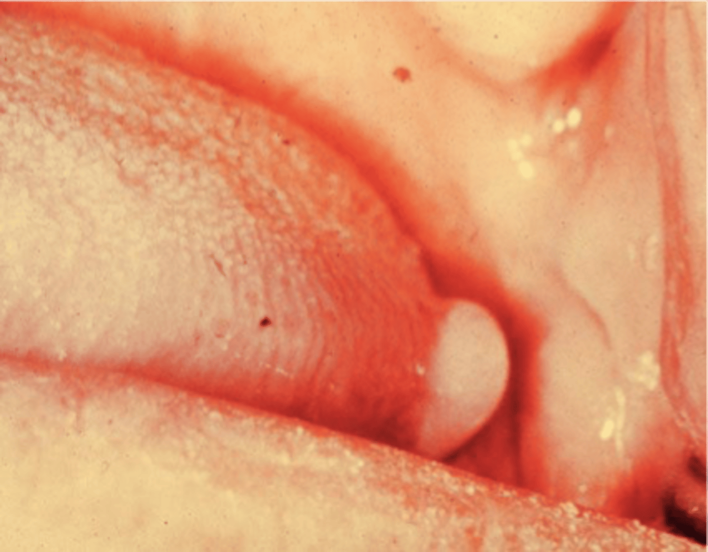 <p>lymphoepithelial cyst</p>