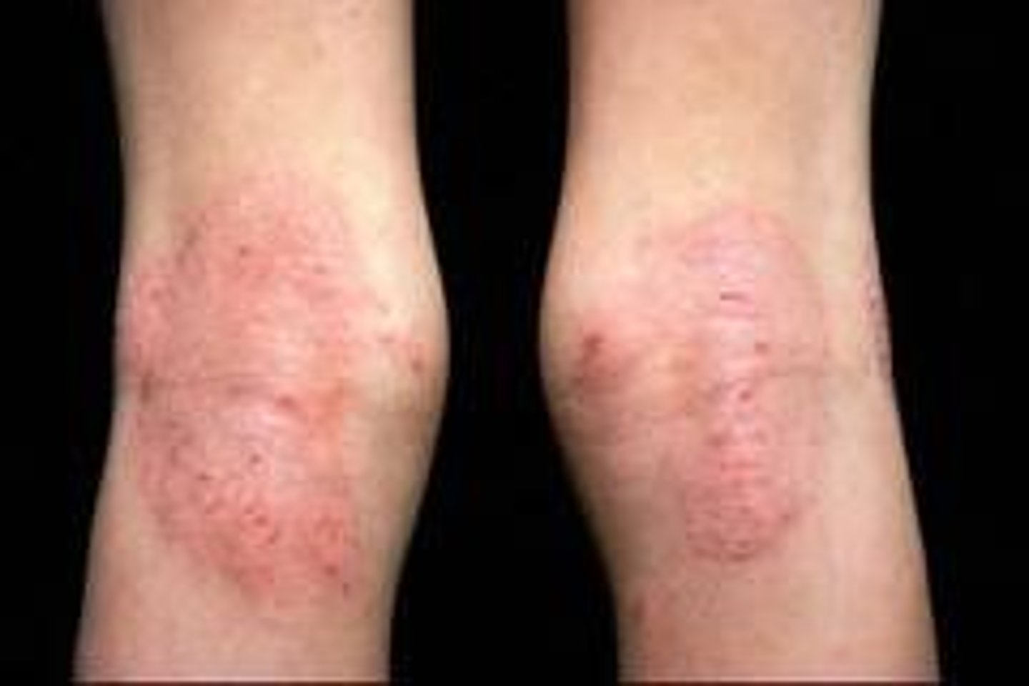 <p>diagnose this image:</p><p>Erythematous papules and plaques with or without scales</p>