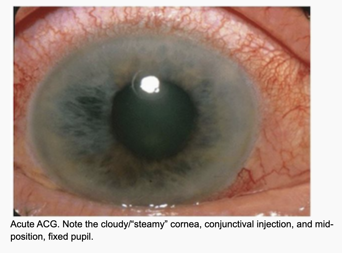 <p>Acute Angle Glaucoma</p>