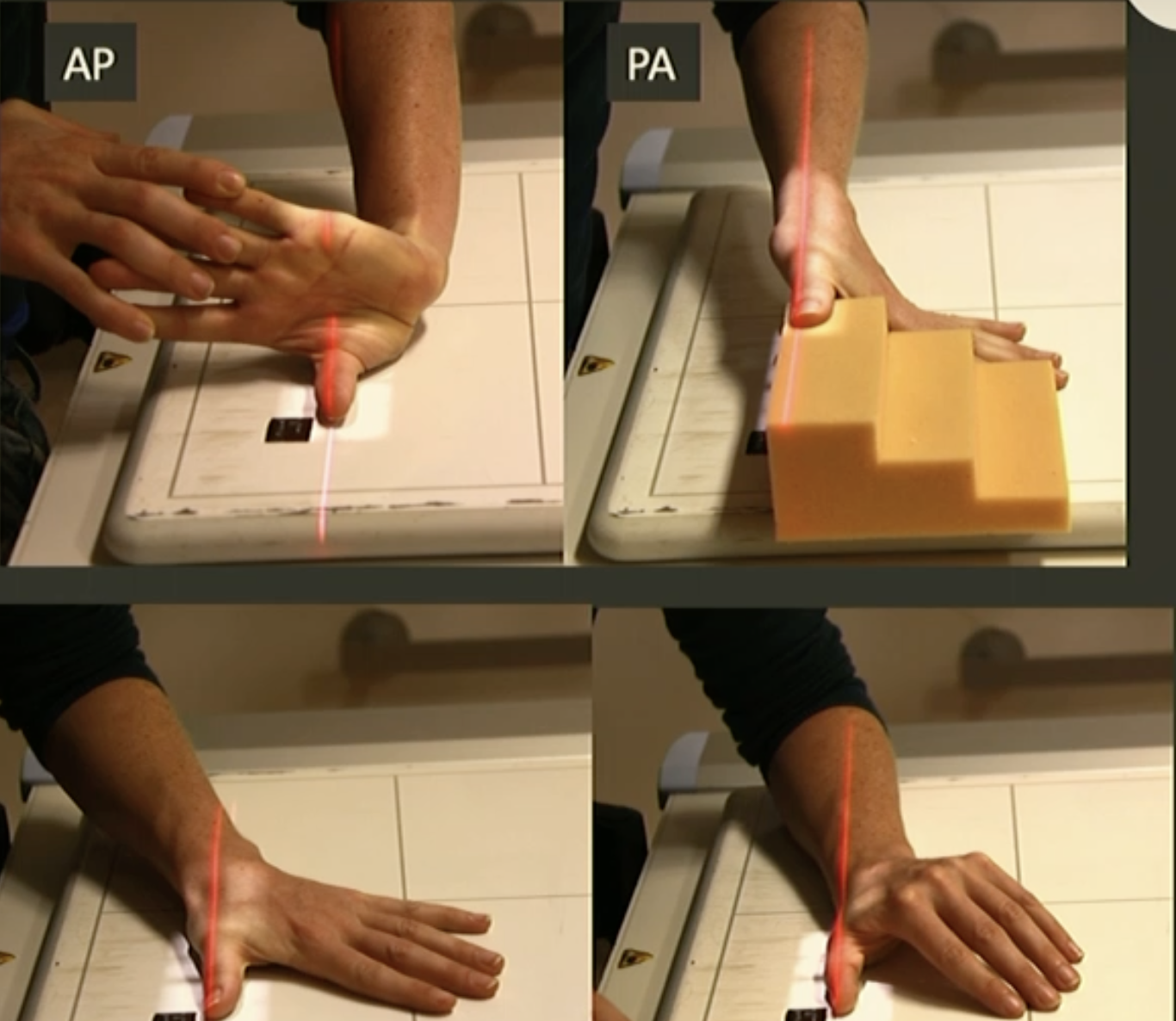 <p>Fine FS, 100cm</p><p>55kVp/1.25mAs</p><p>Straight tube</p><p>CR: Carpometacarpal joint</p>