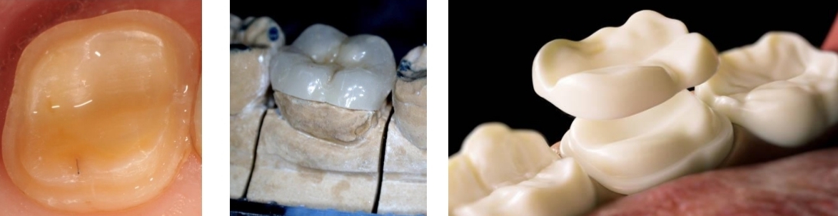 <p>CAD/CAM in lab</p><p class="has-focus"><em>(note that chamfer margin is needed in overlay prep, similar to onlay)</em></p>