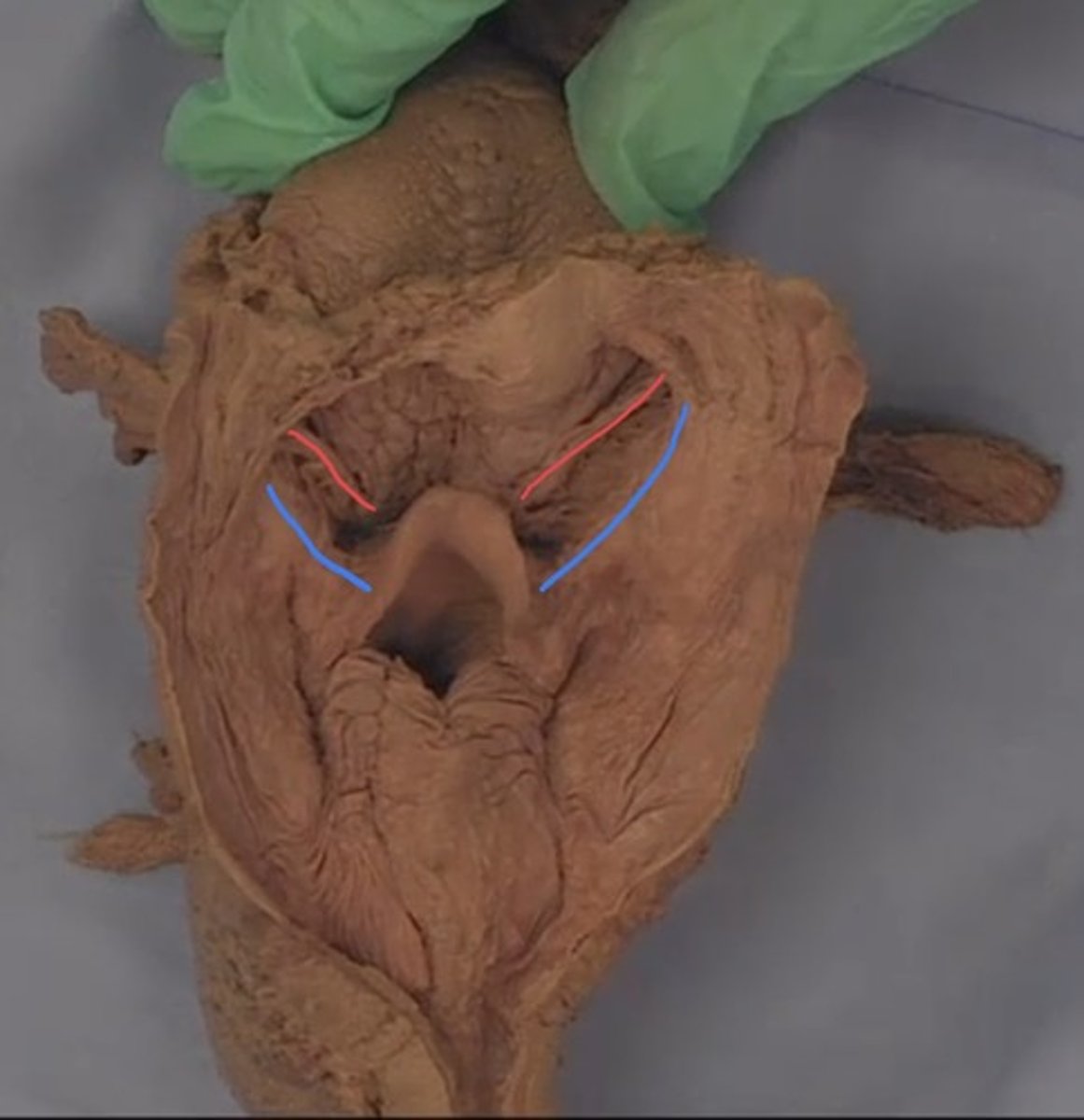 <p>What is the fold colored blue? (constrictor muscles are reflected)</p>