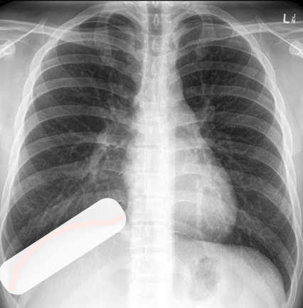 <p>This infiltrate over the the hemi-diaphragm indicates what?</p>