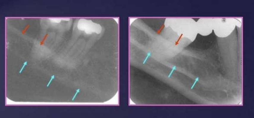 <p>What is the relationship of the external oblique ridge and the mylohyoid ridge?</p>