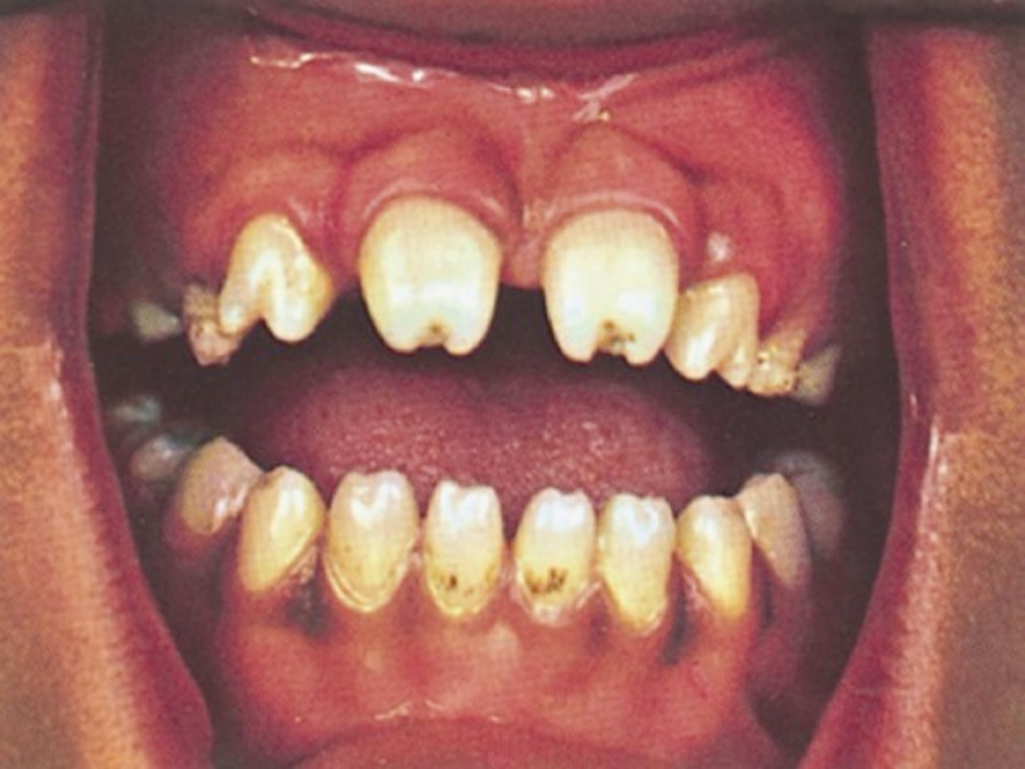 <p>-after 2 years of age, presents with mulberry molars, saber shins, saddle nose , gummatous ulcers</p>