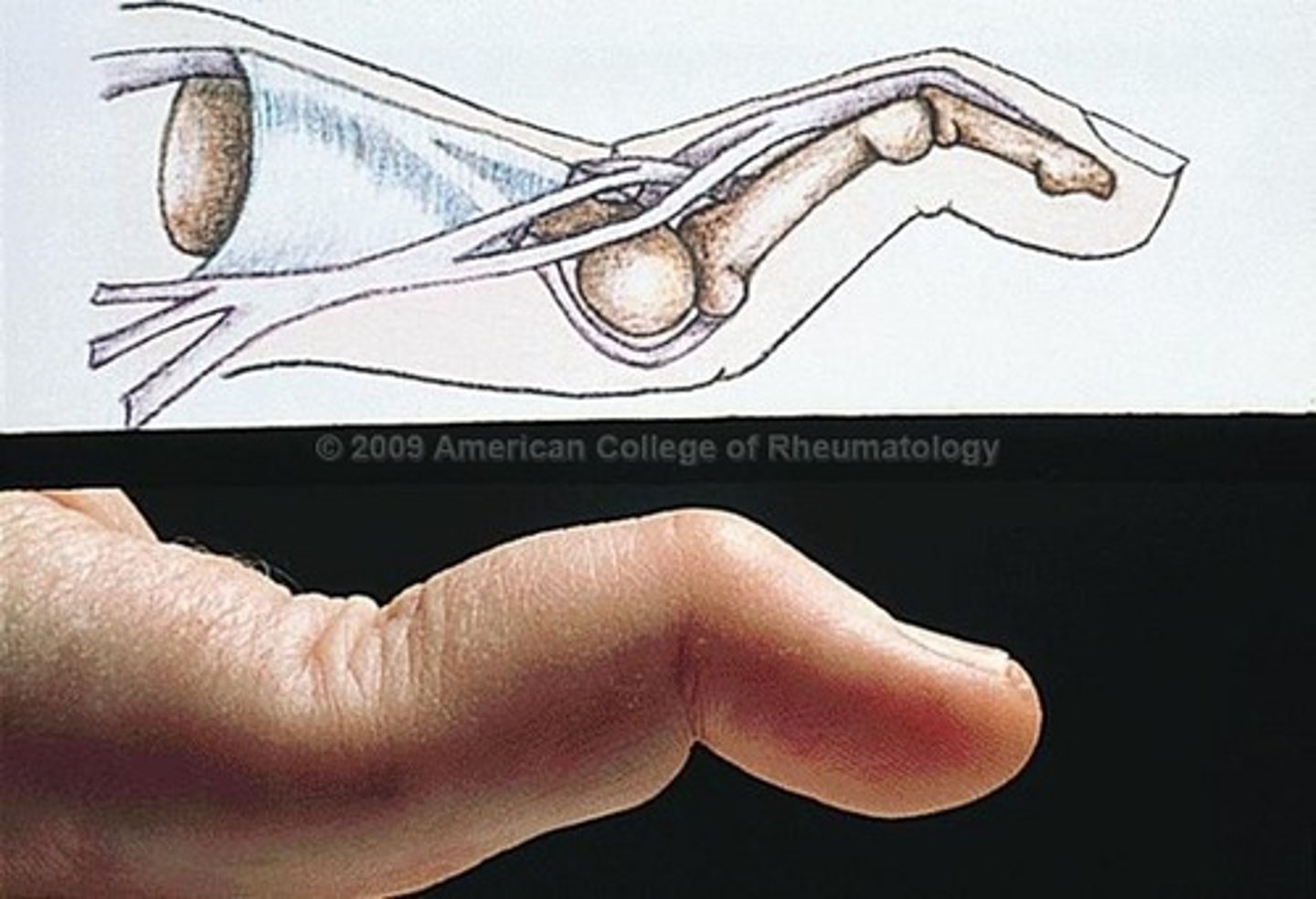 <p>hyperextension of PIP and flexion of DIP, characteristic of rheumatoid arthritis</p>