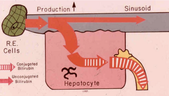 <p>Pre-hepatic jaundice occurs when there is increased production of bilirubin. Conditions such as hemolytic anemia lead to elevated unconjugated bilirubin in the bloodstream before it reaches the liver for conjugation. </p>