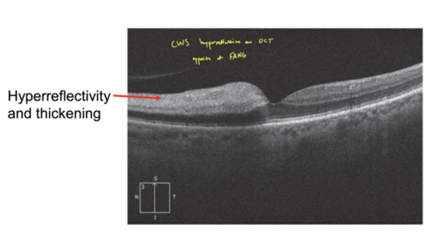 <p>hyperreflectivity and thickening</p><p>think CWS on OCT</p>