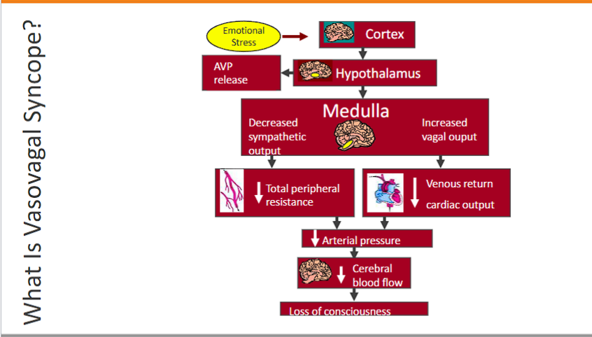 <p>vasal syncope= faint</p><p>syncrope:&nbsp;“cutting off”</p><p><strong><span>Vasovagal syncope</span></strong><span> is a </span><strong><span>sudden, reflex-mediated drop in heart rate and blood pressure</span></strong><span>, the drop in heart rate and blood pressure </span><strong><span>leads</span></strong><span> to a </span><strong><span>temporary reduction in cerebral blood flow </span></strong><span>and</span><strong><span> loss of consciousness</span></strong><span>. It is a </span><strong><span>neurologically triggered cardiovascular collapse</span></strong><span>.</span></p><p><strong><span>1. The Trigger</span></strong></p><ul><li><p class="ds-markdown-paragraph"><strong><span>Emotional Stress:</span></strong><span> Seeing blood, extreme fear, emotional distress.</span></p></li><li><p class="ds-markdown-paragraph"><strong><span>Physical Stress:</span></strong><span> Standing for a long time, severe pain, dehydration, heat exposure.</span></p></li></ul><p><strong><span>2. Cortex&nbsp;</span></strong><span><span>The </span></span><strong><span>cortex interprets a stimulus as a threat</span></strong><span><span> and </span><strong><span>activates the emotional/stress centers</span></strong><span> that ultimately trigger the maladaptive reflex in the brainstem.</span></span></p><ol start="3"><li><p><strong><span>Hypothalamus (Sounds the Alarm &amp; Activates Stress Pathways) AND </span></strong><span>releases AVP (vasopressin) to increase blood pressure, </span><strong><span>the release speed of AVP is slower than the drop in blood pressure, which is why the faint occurs. </span></strong></p></li><li><p>Medulla: decrease sympathetic output and increases vagal tone, which leads to a<strong> decrease in TPR</strong> and<strong> decrease in venous return cardiac output</strong>, leading to a<strong> decrease in AP</strong></p></li><li><p>decrease in arterial pressure leads to<strong>&nbsp;decrease in&nbsp;cerebral blood flow </strong></p></li><li><p>decrease in cerebral blood flow leads to<span style="color: blue;"> faint.&nbsp;</span></p></li></ol><p></p><p></p>